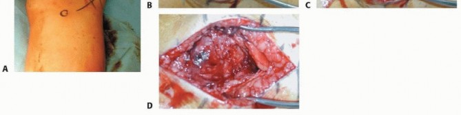 Illustration 67 for Repairing Distal Femur Fractures: Open Reduction & Internal Fixation