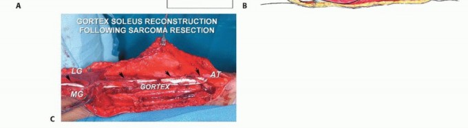 Illustration 12 for Soleus Resection for Tumors: Protecting the Heads of the Gastrocnemius