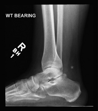 Understanding Achilles Rupture: The Watershed Zone Proximal to the Insertion