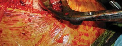 Illustration 87 for S-ROM: Inside the Technique of Modular Implant Design