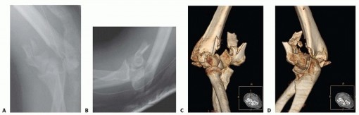 Open Reduction and Internal Fixation of Supracondylar and Intercondylar Fractures