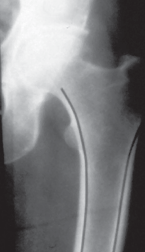 Illustration 15 for Cementless Femoral Stems: Master Indications & Avoid Pitfalls