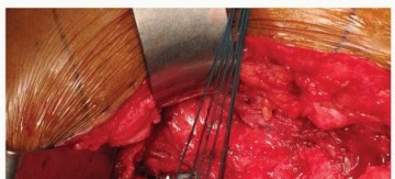 Illustration 33 for Uncemented Acetabular Revision: Optimizing Hemispherical Cup Use