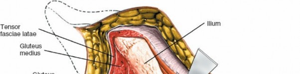 Illustration 47 for Unlocking Every Aspect of the Hip's Surgical Approaches