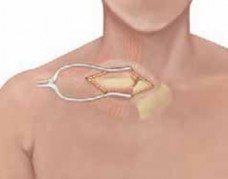 Illustration 18 for Mastering Pediatric Shoulder Fractures: Clinical Insights