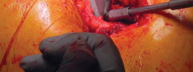 Illustration 47 for Unlock better THA: The technique of short stem for less invasiveness