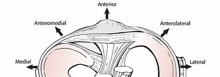 Illustration of knee dislocation femorotibial - Dr. Mohammed Hutaif
