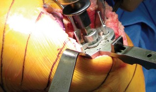 Illustration 18 for Minimally Invasive Subvastus: The Best Path to Quicker TKA Recovery