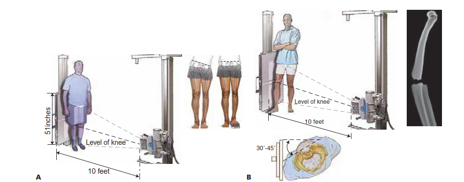 Illustration 2 for Knee Arthrodesis: A Lifelong Knee Solution for Trauma & TKA