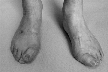 Hallux Valgus Exam Prep: Master Oral Questions Hallux Scenarios