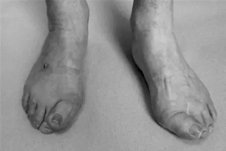 صورة توضيحية لـ إبهام القدم الأروح (الوكعة): دليل شامل للتشخيص والعلاج مع الأستاذ الدكتور محمد هطيف في صنعاء