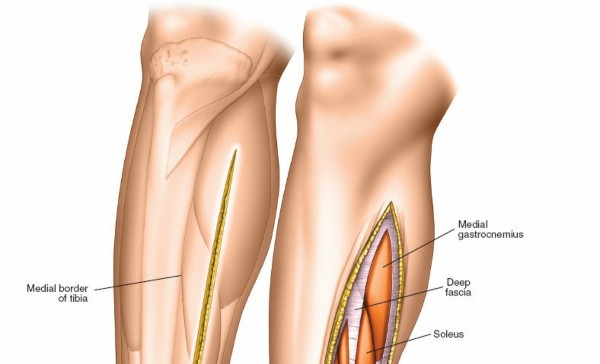 Illustration 113 for Surgical Access: Mastering the Tibia's Surface & Fibula Approaches