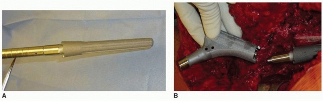 Illustration 15 for Optimizing Revision THA with Tapered Fluted Titanium Stems