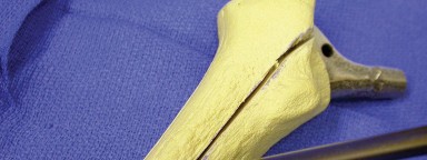 Illustration 20 for Achieving Success with Trochanteric Osteotomy Posterior for Revision