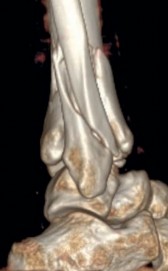 Illustration 18 for Decoding Pilon Fractures: Anterolateral and Medial Fragments Revealed