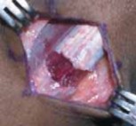 Illustration 12 for Unlocking Mobility: Distal Lengthening for Lateral Hamstring Muscle