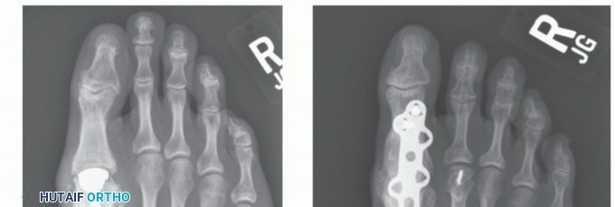 Illustration 73 for End Articular Cartilage Loss: Arthrosurface HemiCAP Resurfacing