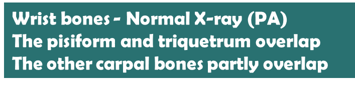 Illustration of carpal fractures and dislocations - Dr. Mohammed Hutaif