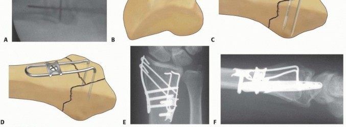Illustration 41 for Fragment-Specific Fixation: Restore Carpal Facet Horizon