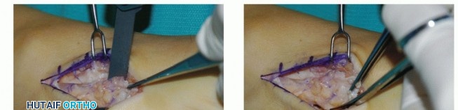 Illustration 5 for Restore Movement: Tendon Transfer for Common Peroneal Nerve Foot Drop