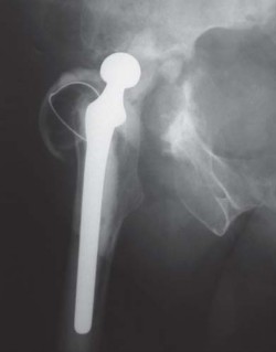 Illustration 3 for Management of Periprosthetic Fractures: An Expert Surgical Guide