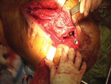 Illustration 44 for THA for patients with proximal femoral deformity: Practical solutions