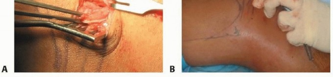Illustration 19 for Chronic Patellar Instability: From Acute Onset to Lasting Solutions