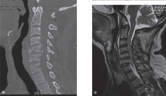 Illustration 8 for Spondylodiscitis: Deciphering the next course of action