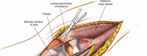 Illustration 9 for Mastering Elbow Approaches: Applied Surgical Anatomy for Precision