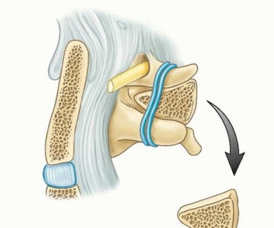 Illustration 31 for Addressing Cervical Spine Instability with Posterior Arthrodesis
