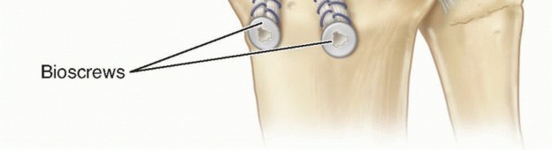 Illustration 15 for Repair & Recover from Collateral Ligament Injuries: Your Guide