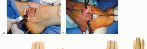 Illustration 31 for How Achilles Tendon Lengthening Fixes Equinocavovarus Foot