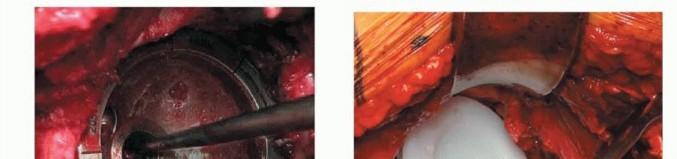 صورة طبية: استبدال مفصل الورك بدون أسمنت: استعادة الحركة والثبات في صنعاء مع الأستاذ الدكتور محمد هطيف