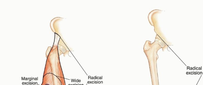 Illustration 27 for Understanding Benign Bone Tumors: Your Complete Preoperative Guide