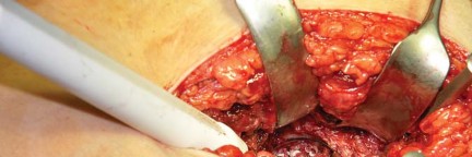 Illustration 17 for Collum Femoris Preserving: Achieve Better Primary Hip Outcomes