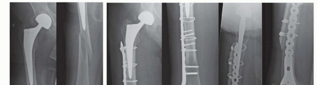 Illustration 15 for Mastering Fixation of Periprosthetic Fractures of the Femur