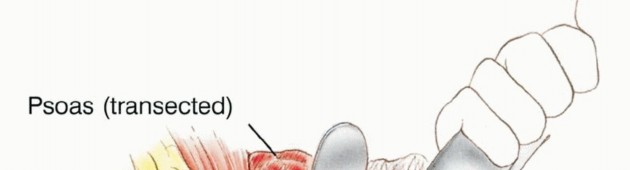 Illustration 13 for Posterior Flap Hemipelvectomy: Mastering Techniques for Optimal Outcomes