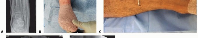 Illustration 29 for Advanced Nailing of the Mature Tibia: Overcoming Complexities