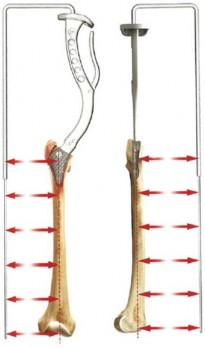 Illustration 14 for The Proxima: Why This Proximally Loading Implant Preserves Bone