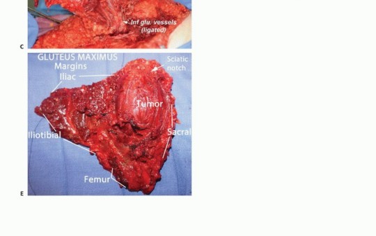 Illustration 17 for Beyond Hemipelvectomy: Preservation of the Sciatic in Buttock Surgery