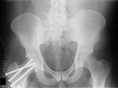 Illustration 111 for OrthoCash: Trauma MCQs & Cases for a yearold woman