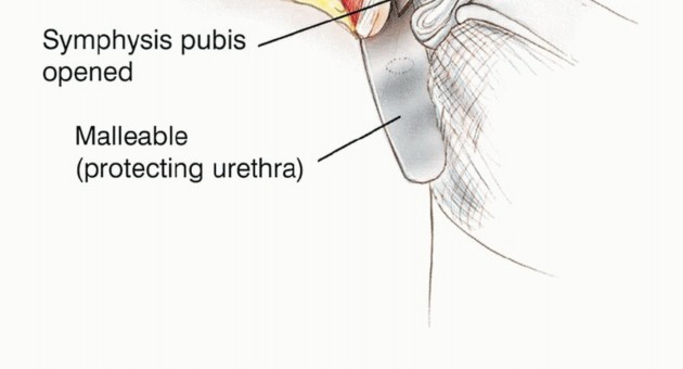 Illustration 15 for Posterior Flap Hemipelvectomy: Mastering Techniques for Optimal Outcomes
