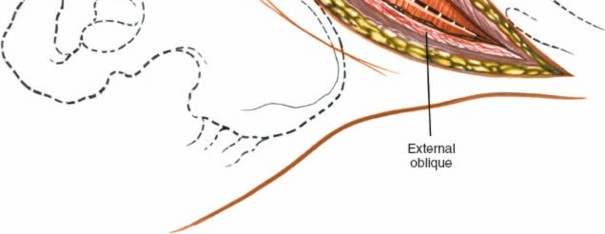 Illustration 141 for Approach to the Lumbar Spine: Mastering Techniques & Anatomy