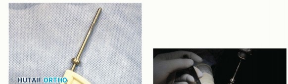 Illustration 33 for End Articular Cartilage Loss: Arthrosurface HemiCAP Resurfacing