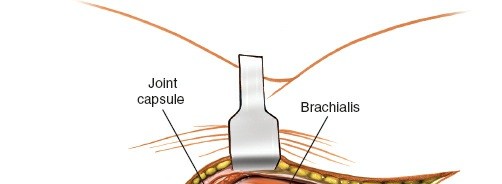 Illustration 6 for Medial Approach to the Distal Humerus: Master Techniques & Avoid Osteotomy