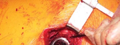 Illustration 37 for Exploring the Ambulatory Surgical Setting for Total Hip Replacement