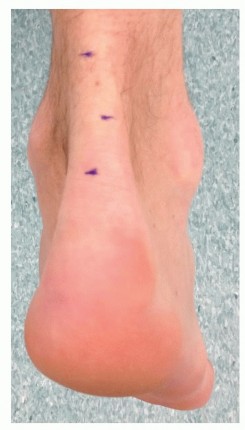 Restore Ankle Mobility: Lengthening the Gastrocnemius and Soleus
