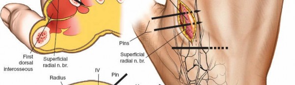 Illustration 14 for Key Approaches for External Fixation: Humerus, Radius, Ulna, Wrist