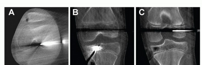Illustration 18 for Preventing Growth Plate Risk: ACL Reconstruction Using Autogenous Grafts