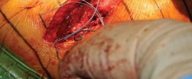 Illustration 32 for Approaches Posterolateral Surgical: A Guide to Enhanced Hip Surgery